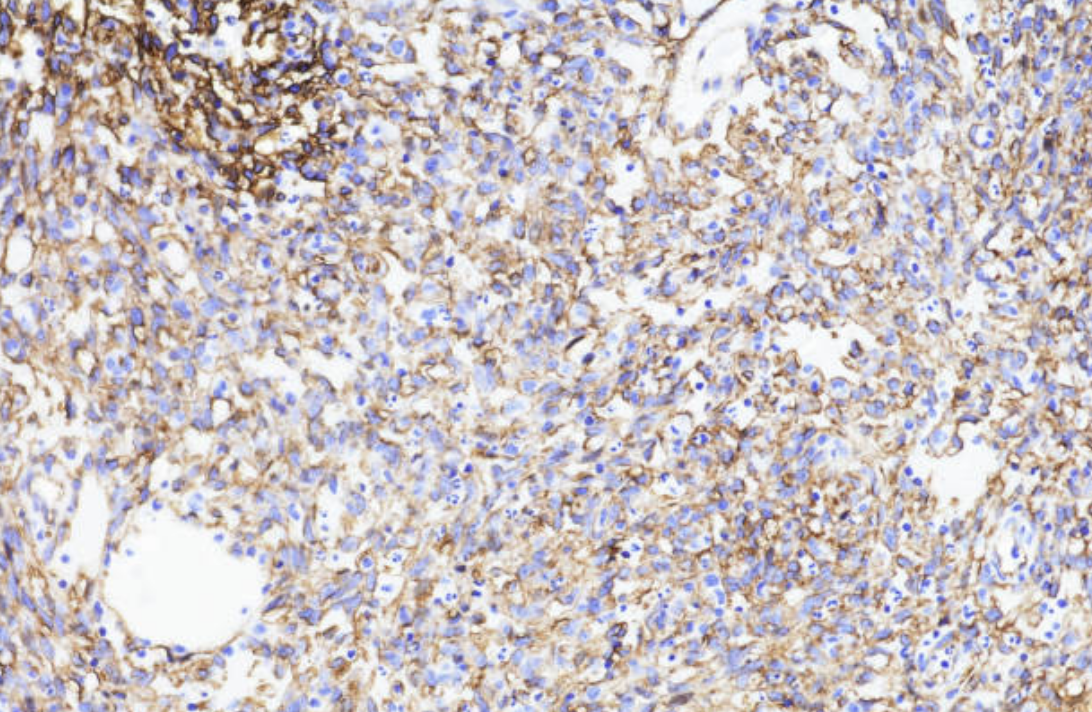 Sentinel Lymph Node Biopsy/Evaluation